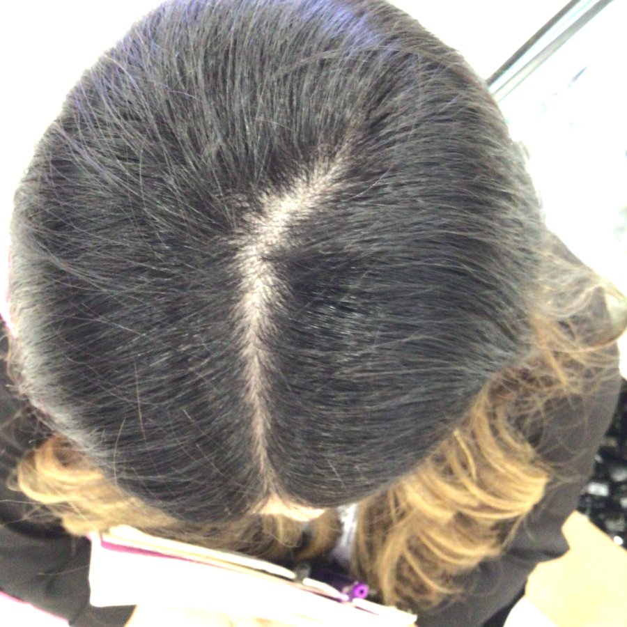 Crown before root coverage